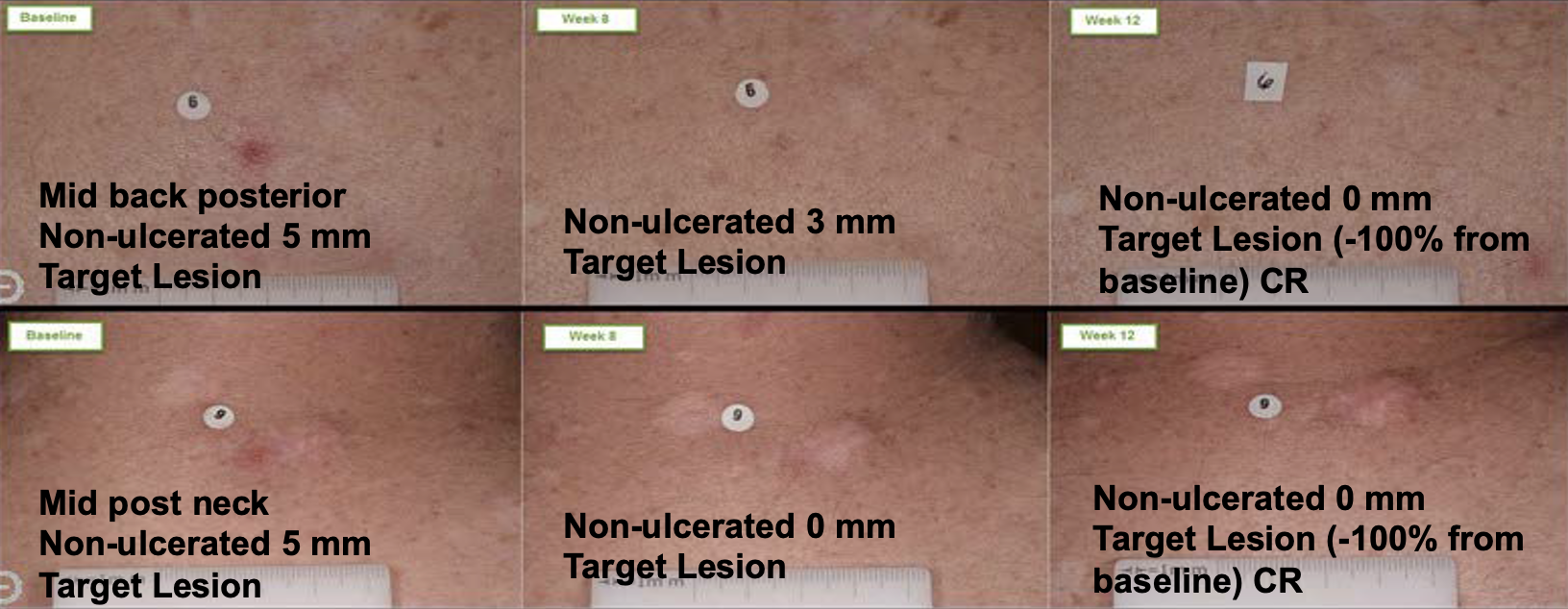 TARGET LESION RESPONSES